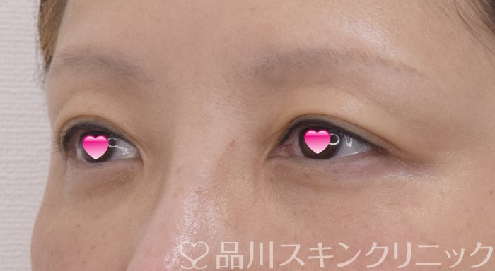 症例NO.74272のAFTER写真