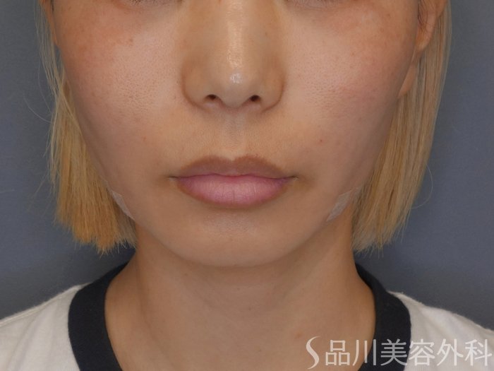 症例NO.74437のAFTER写真