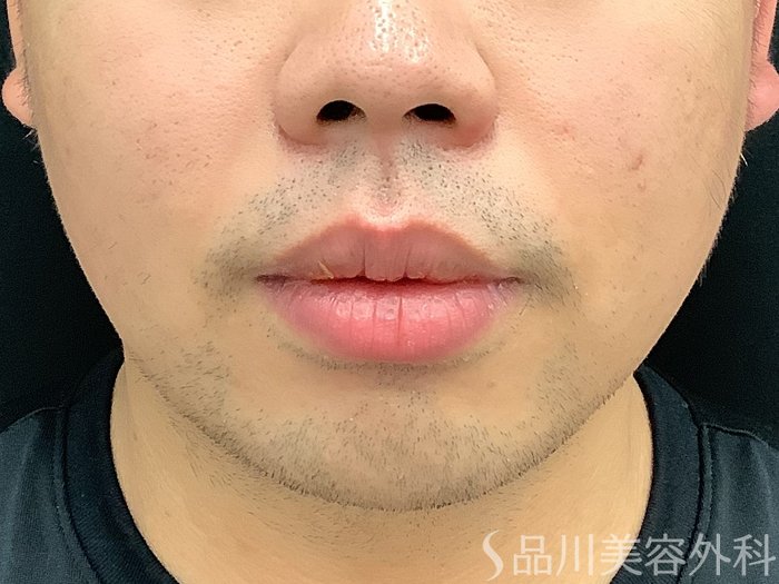 症例NO.67909のBEFORE写真