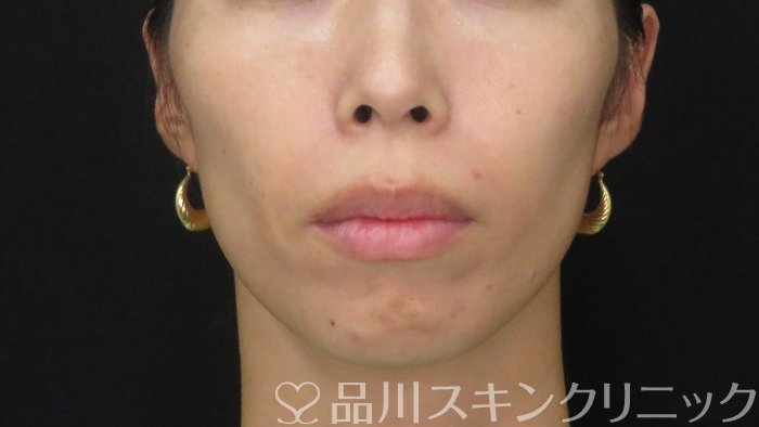 症例NO.72232のBEFORE写真