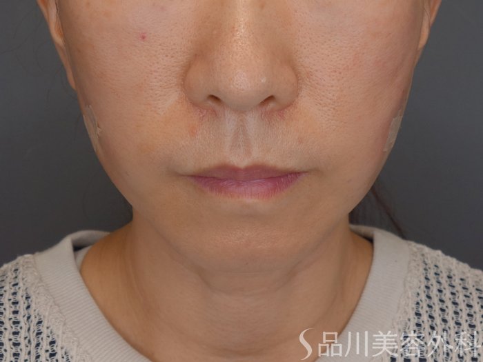 症例NO.72423のAFTER写真