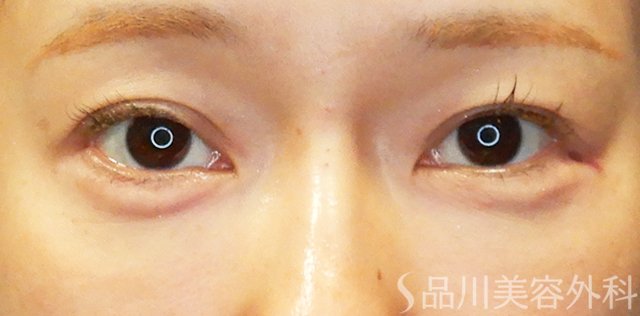 症例NO.67709のAFTER写真