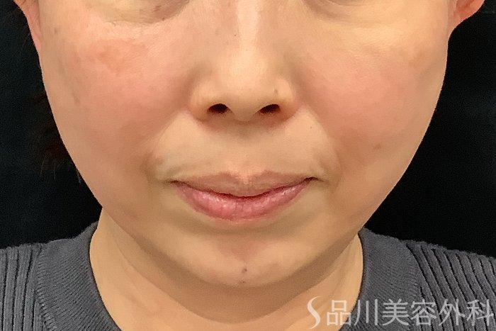 症例NO.73326のAFTER写真