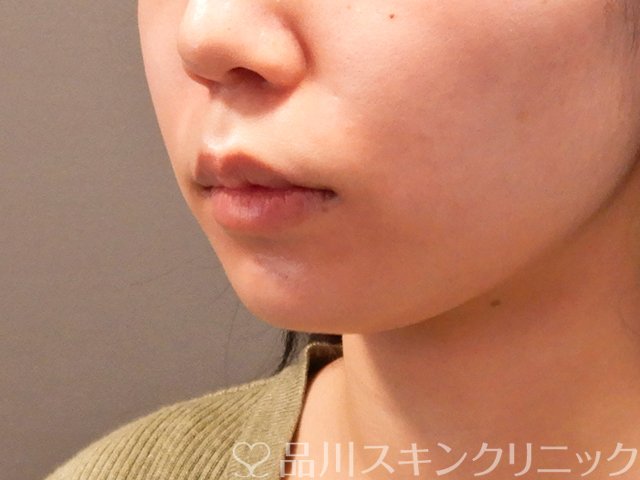 症例NO.69914のBEFORE写真