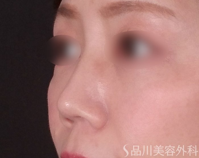 症例NO.69607のBEFORE写真