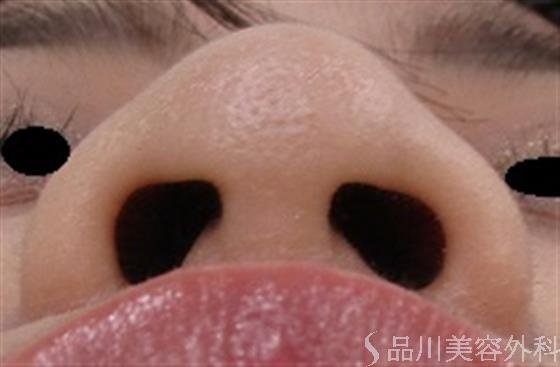 症例NO.37279のBEFORE写真