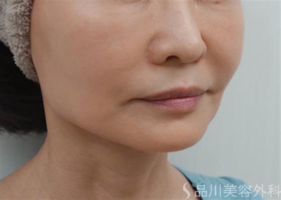 症例NO.25490のBEFORE写真