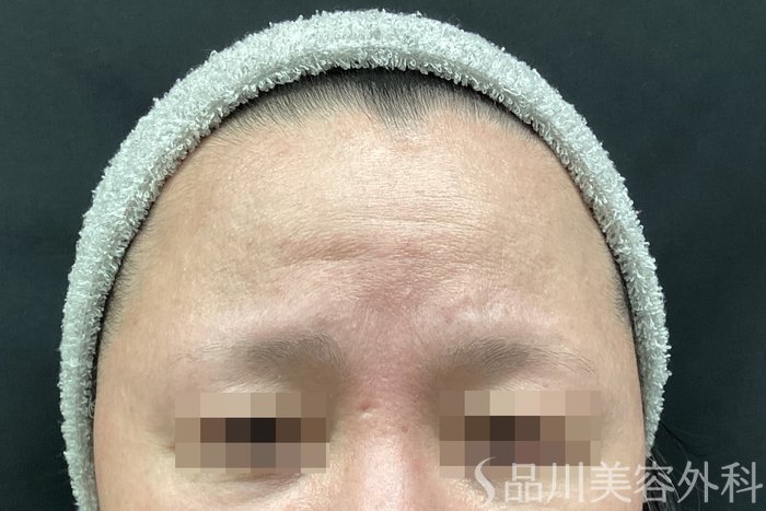 症例NO.67802のBEFORE写真