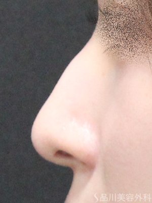 症例NO.75260のBEFORE写真