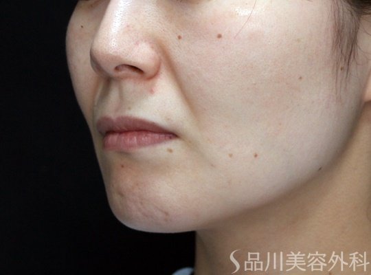 症例NO.70260のBEFORE写真