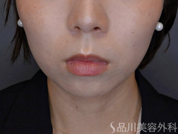 症例NO.74105のBEFORE写真