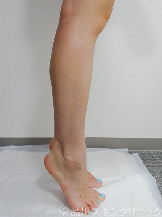 症例NO.73703のAFTER写真