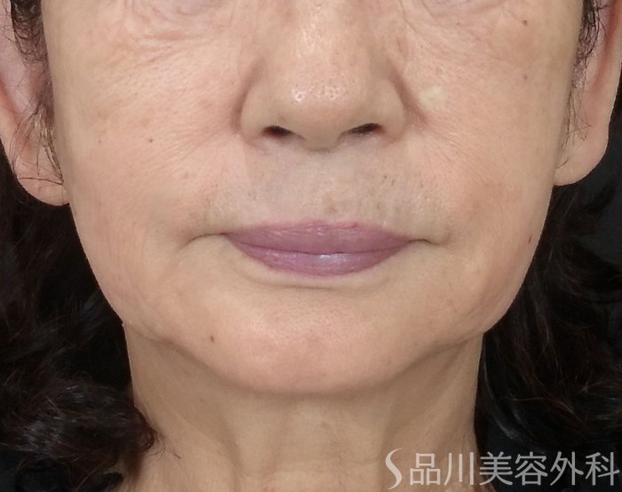 症例NO.65487のBEFORE写真