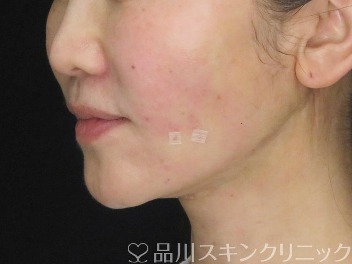 症例NO.65063のAFTER写真