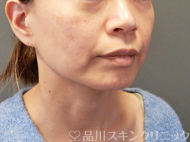 症例NO.63835のBEFORE写真
