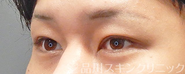 症例NO.74756のAFTER写真