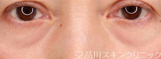 症例NO.59170のBEFORE写真