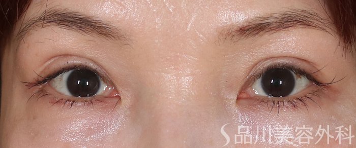 症例NO.73461のAFTER写真