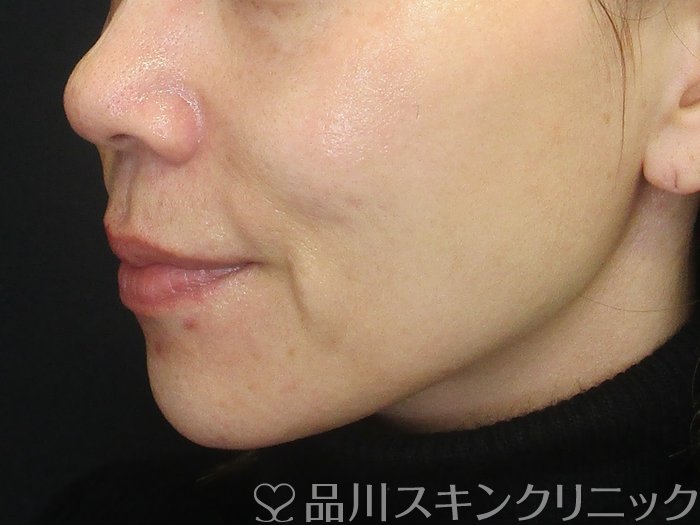 症例NO.72854のBEFORE写真