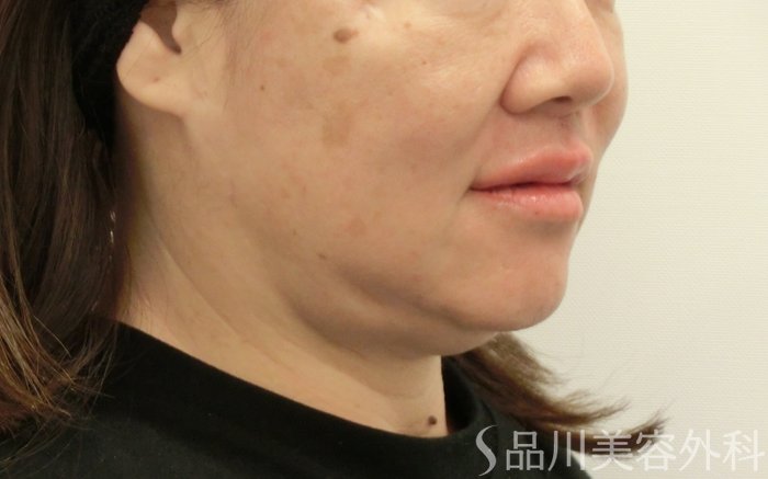 症例NO.73678のAFTER写真