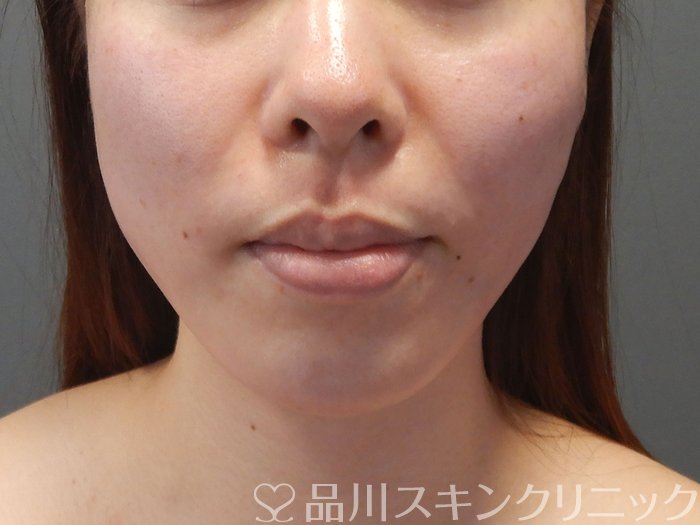 症例NO.71856のAFTER写真