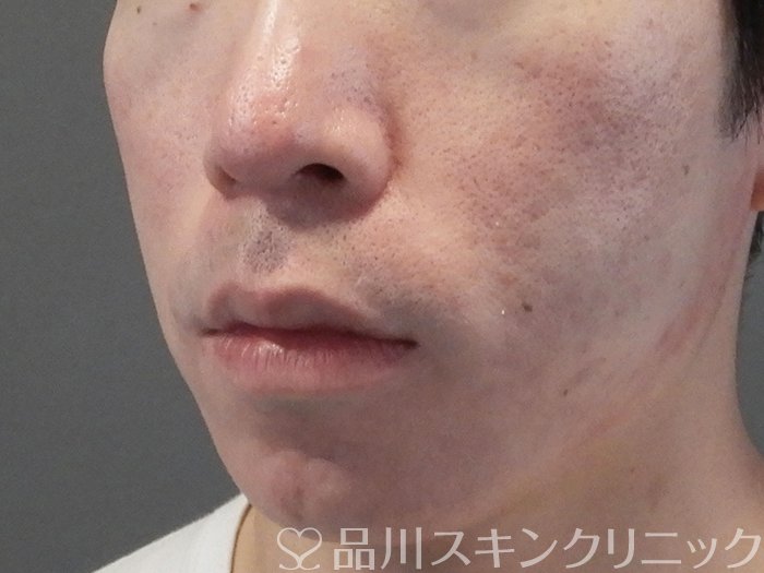 症例NO.69377のAFTER写真