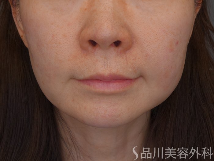 症例NO.69278のBEFORE写真