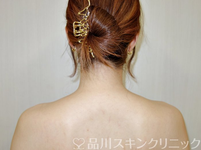 症例NO.73175のBEFORE写真