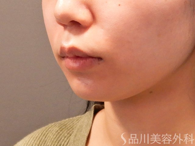 症例NO.69914のBEFORE写真