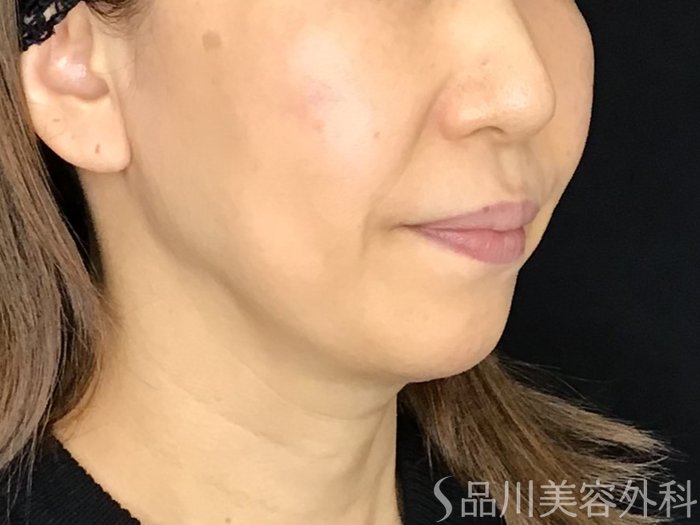 症例NO.69510のBEFORE写真