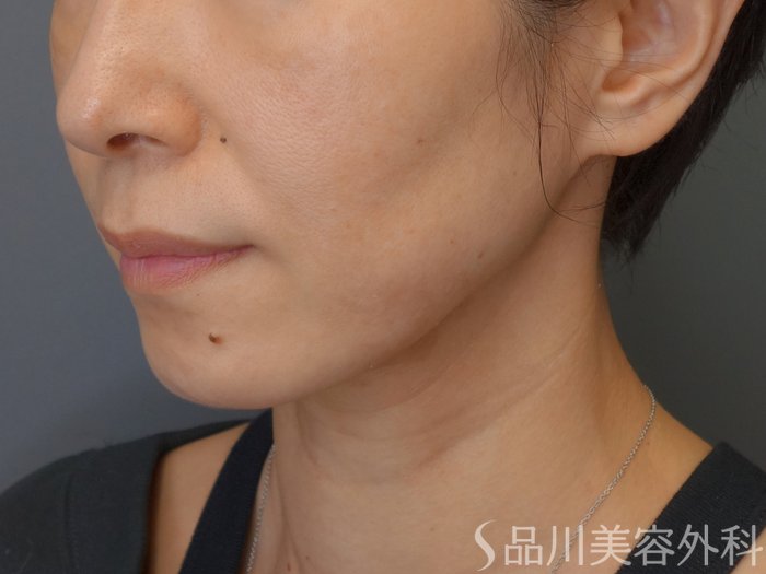 症例NO.72182のBEFORE写真