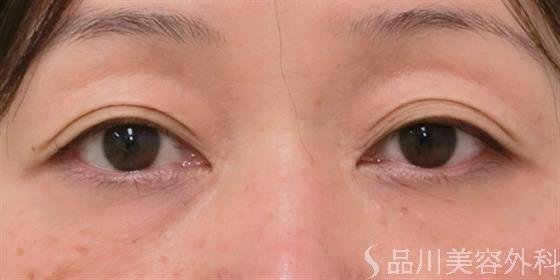 症例NO.26320のBEFORE写真