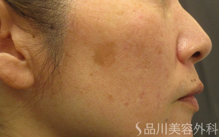 症例NO.71265のBEFORE写真
