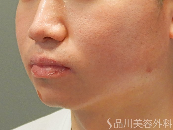 症例NO.70516のAFTER写真