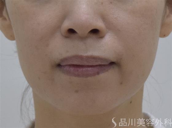 症例NO.50468のBEFORE写真