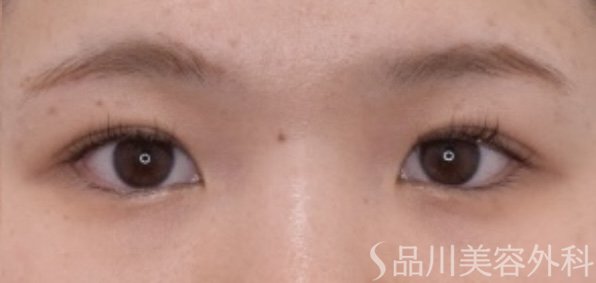 症例NO.67311のAFTER写真