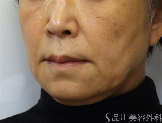症例NO.40102のBEFORE写真
