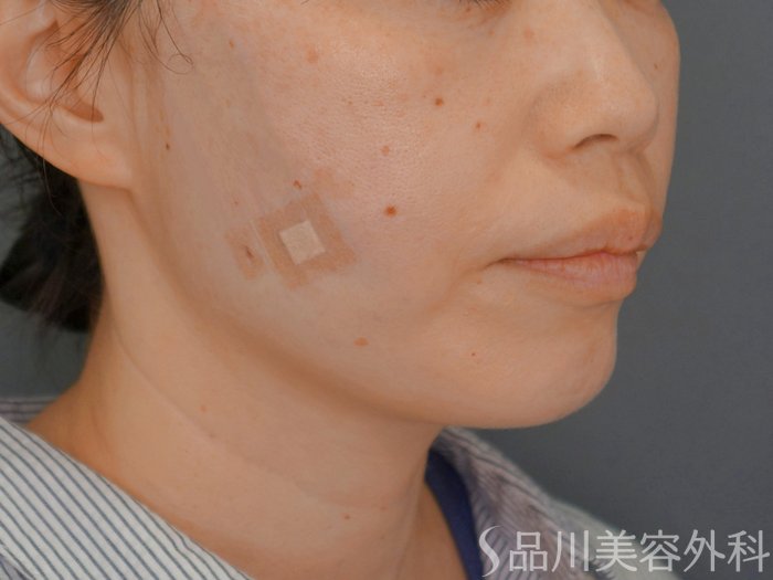 症例NO.74909のAFTER写真