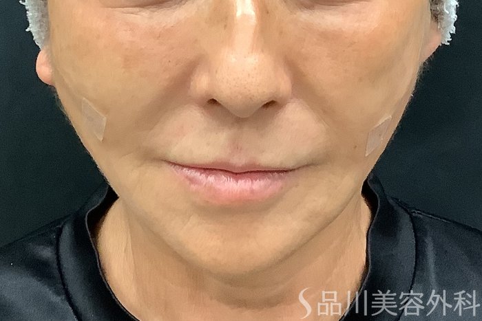 症例NO.67806のAFTER写真
