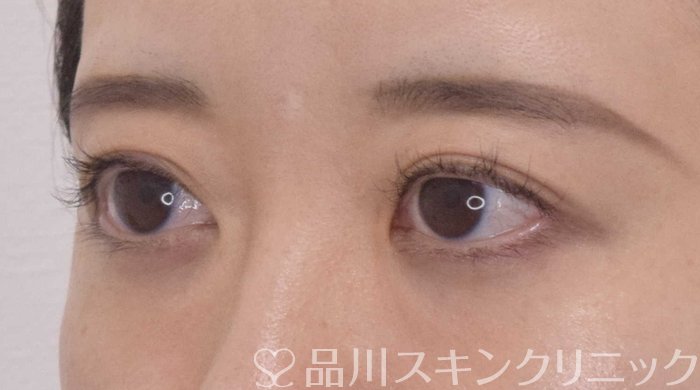 症例NO.62844のAFTER写真