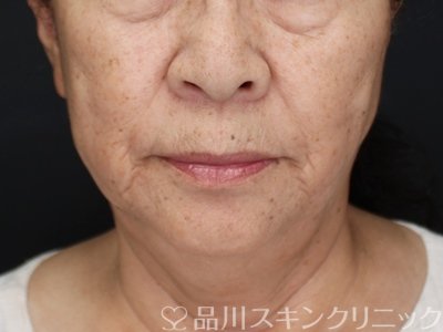 症例NO.72617のAFTER写真