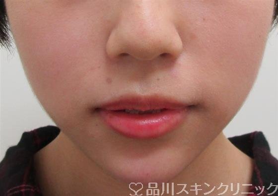 症例NO.30724のAFTER写真