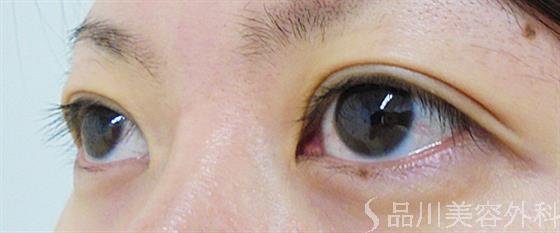 症例NO.29072のAFTER写真