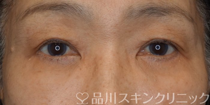 症例NO.74677のBEFORE写真
