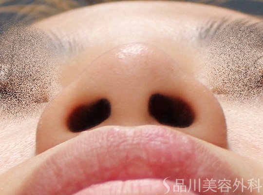 症例NO.67878のBEFORE写真