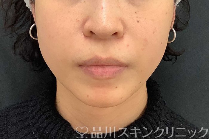 症例NO.69519のAFTER写真