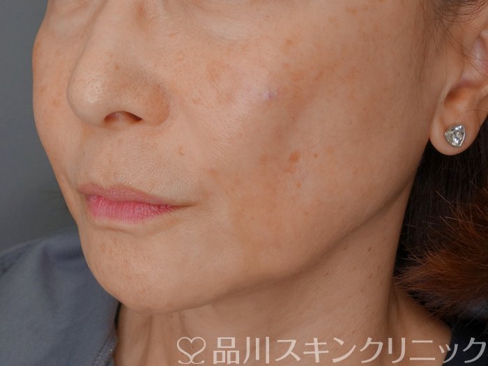 症例NO.73061のAFTER写真