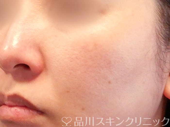 症例NO.65543のAFTER写真