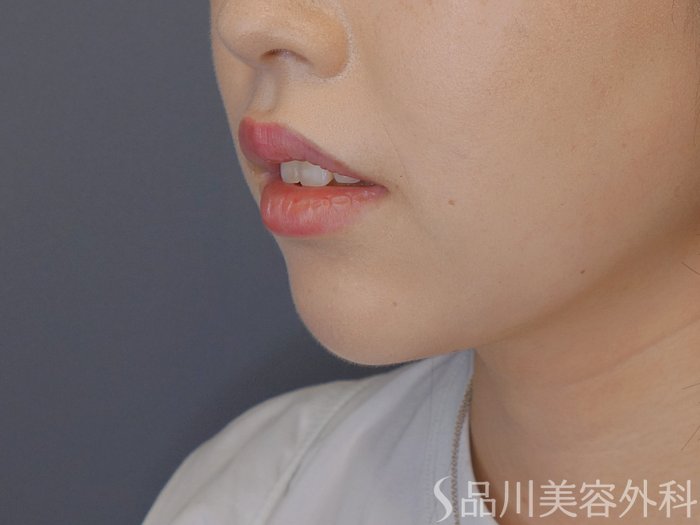 症例NO.71056のBEFORE写真