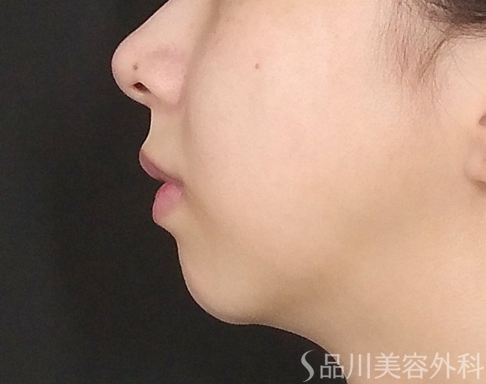 症例NO.71688のBEFORE写真